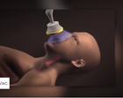 LifeVac Choking Airway Clearing Device - 1/CS